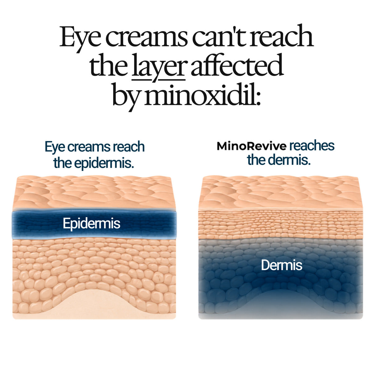 Minoxidil damages the dermis layer, deeper than where eye creams reach the epidermis